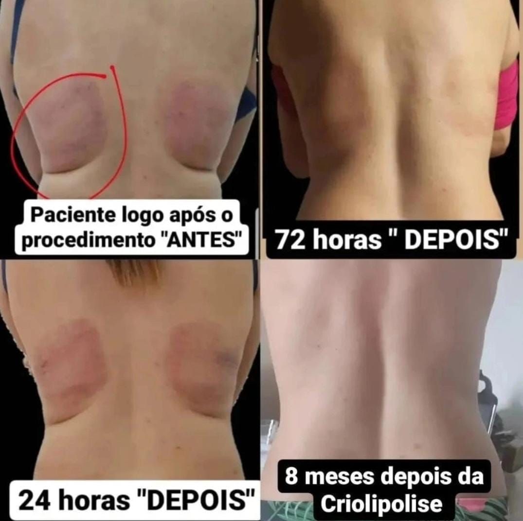 Antes e depois criolipólise