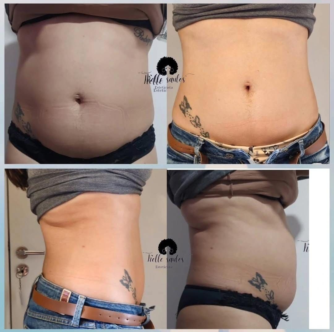 Antes e depois abdômen frontal e lateral