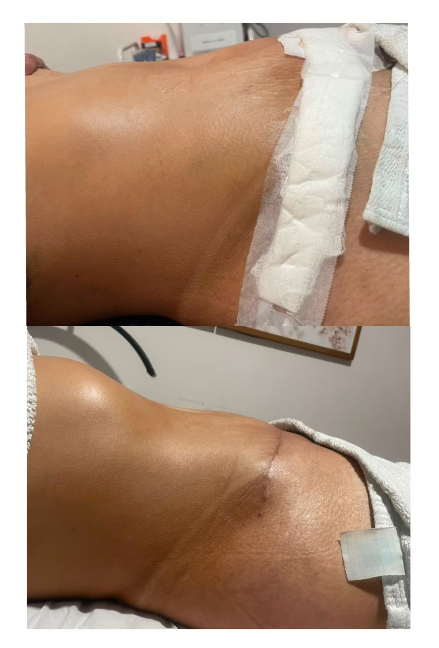 Antes e depois abdômen