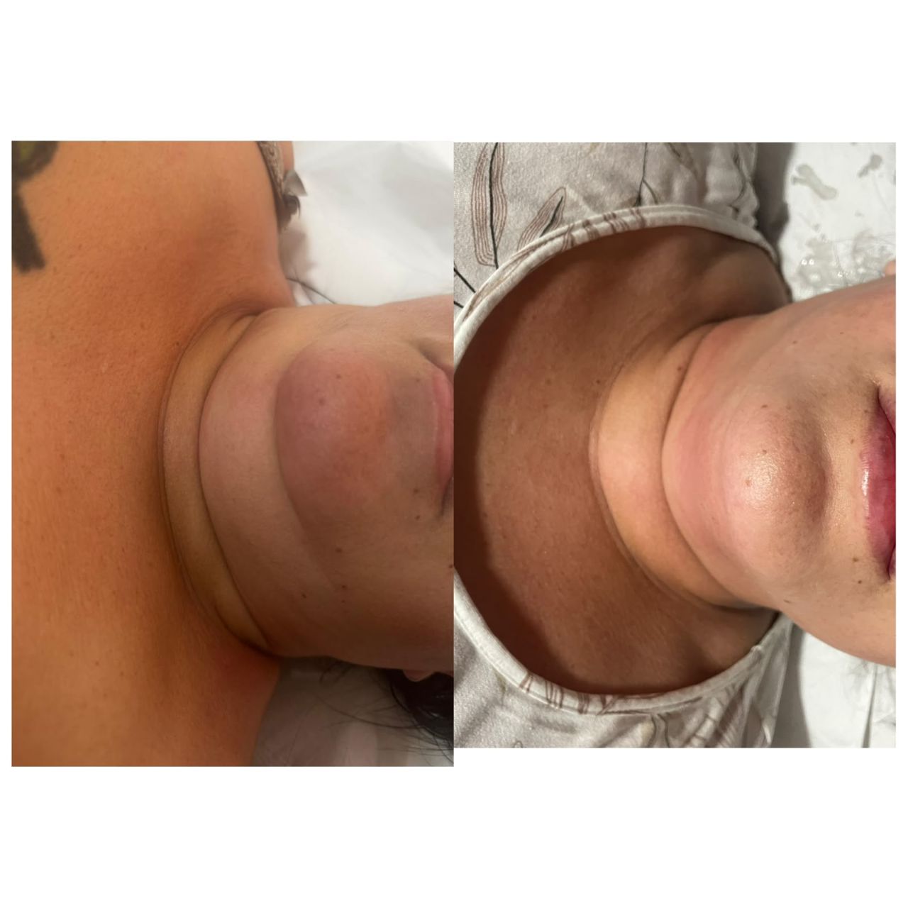 Antes e depois papada