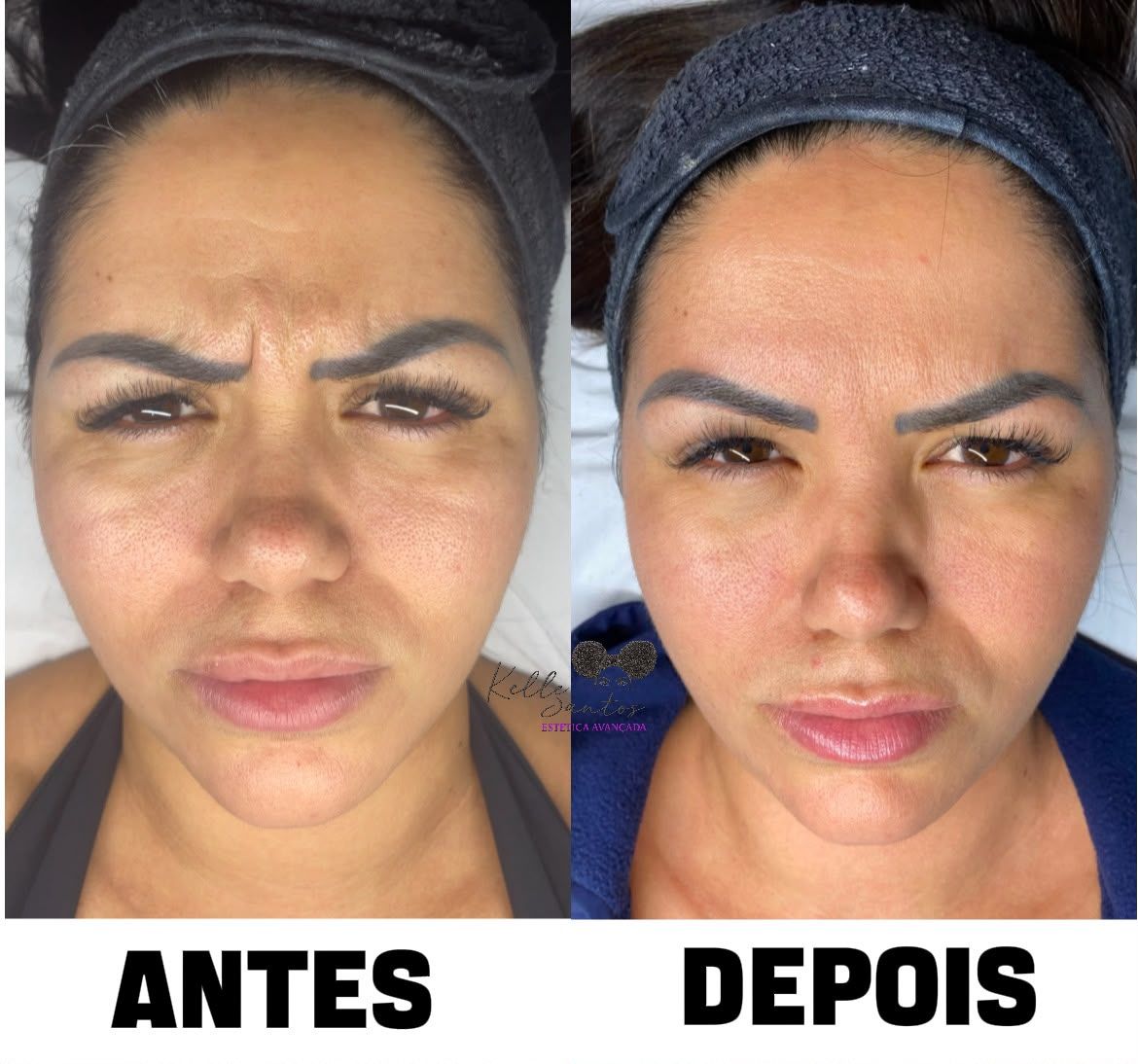 Resultado de aplicação de Botox