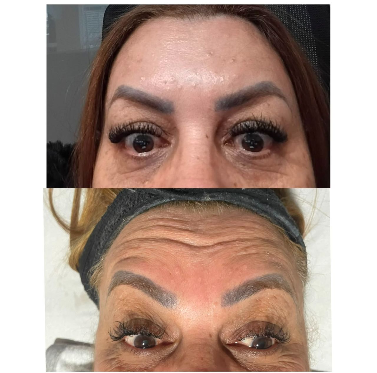 Detalhe de resultado de Botox