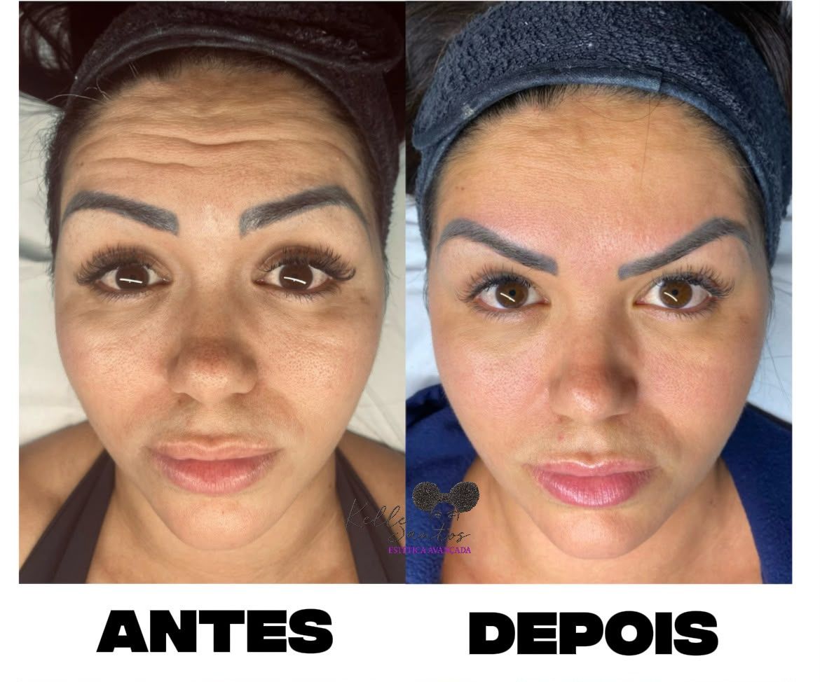Efeito suavizante de Botox