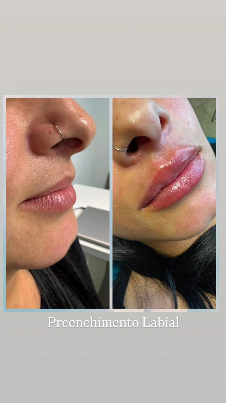 Preenchimento labial - resultado real