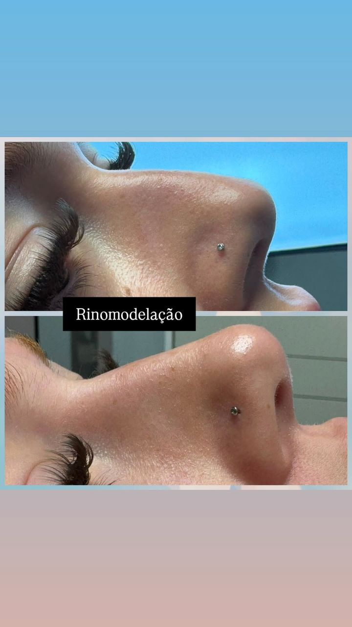 Rinomodelação - perfil real